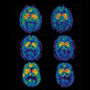 Parkinson’s and Me